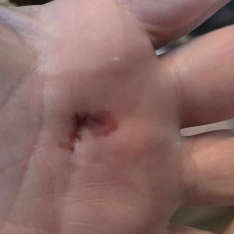 Hand Injury - Screwdriver Slip